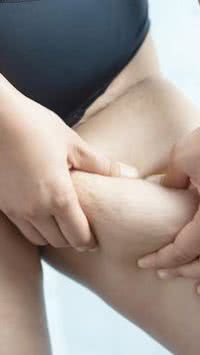 Entenda os sinais do lipedema e como tratar